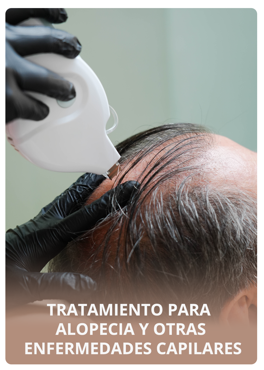 alopecia