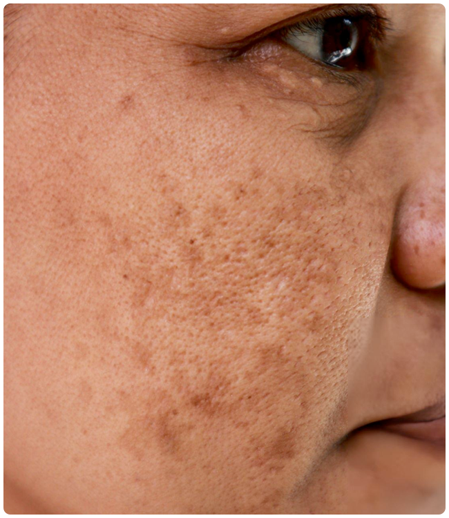 padecimiento-piel-Melasma