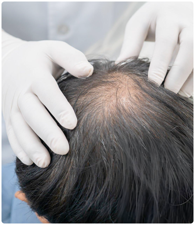 padecimientos_piel-alopecia